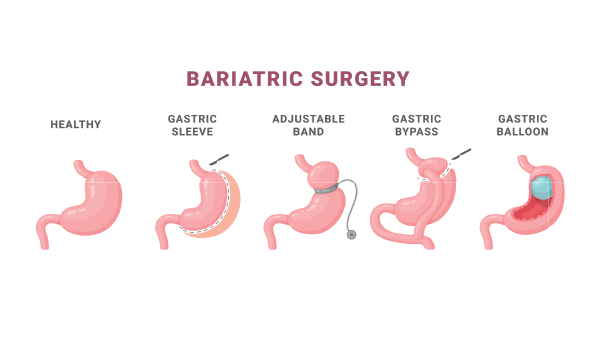 Types of Bariatric Surgery