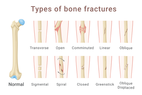 Common Types of Fractures