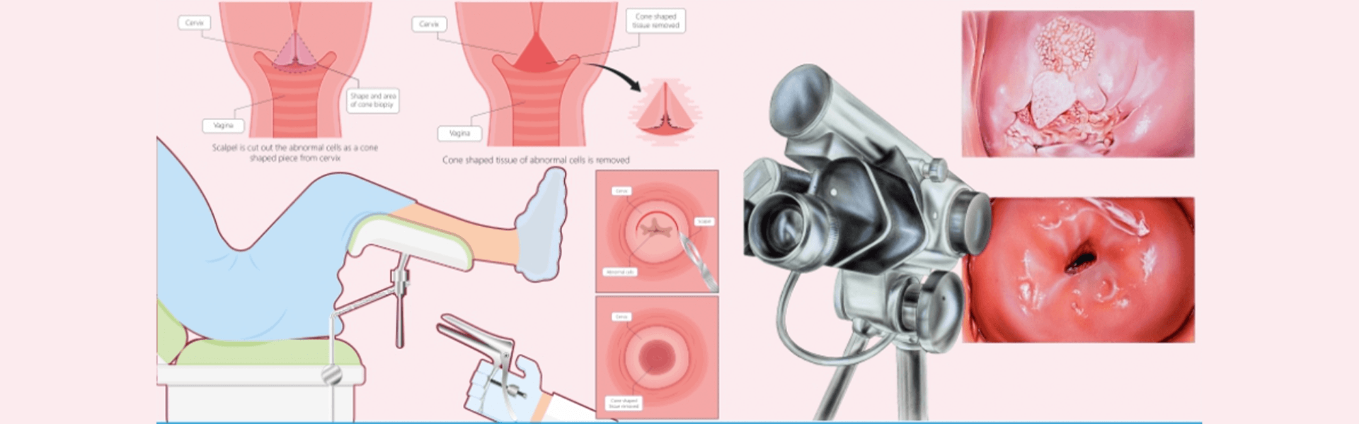 Colposcopy Clinic in Bangalore