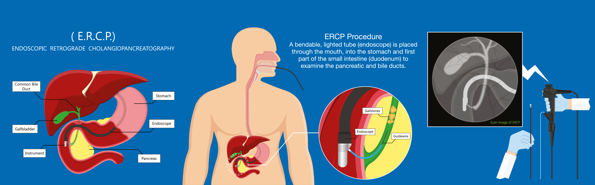 ERCP  Endoscopic Retrograde Cholangiopancreatography in India - Manipal