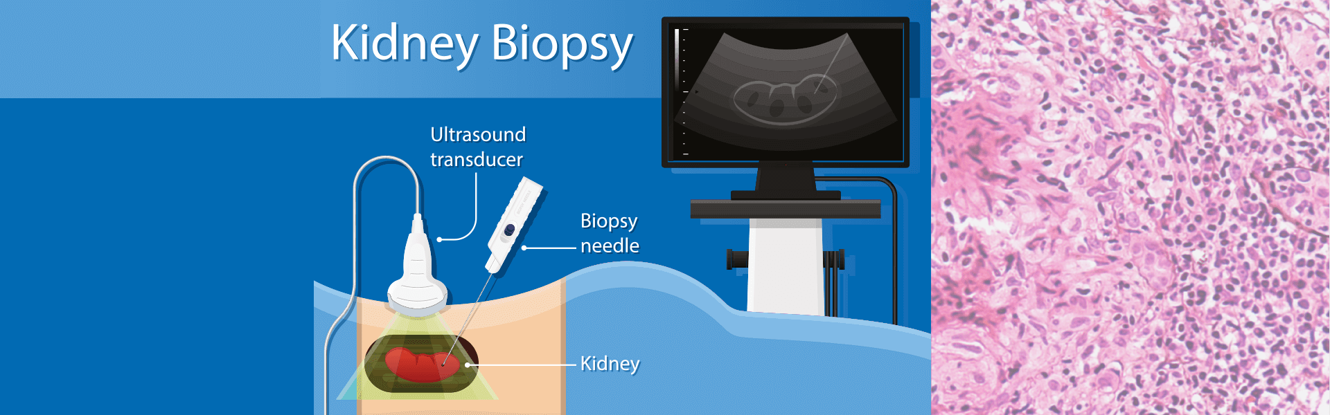 Kidney Biopsy