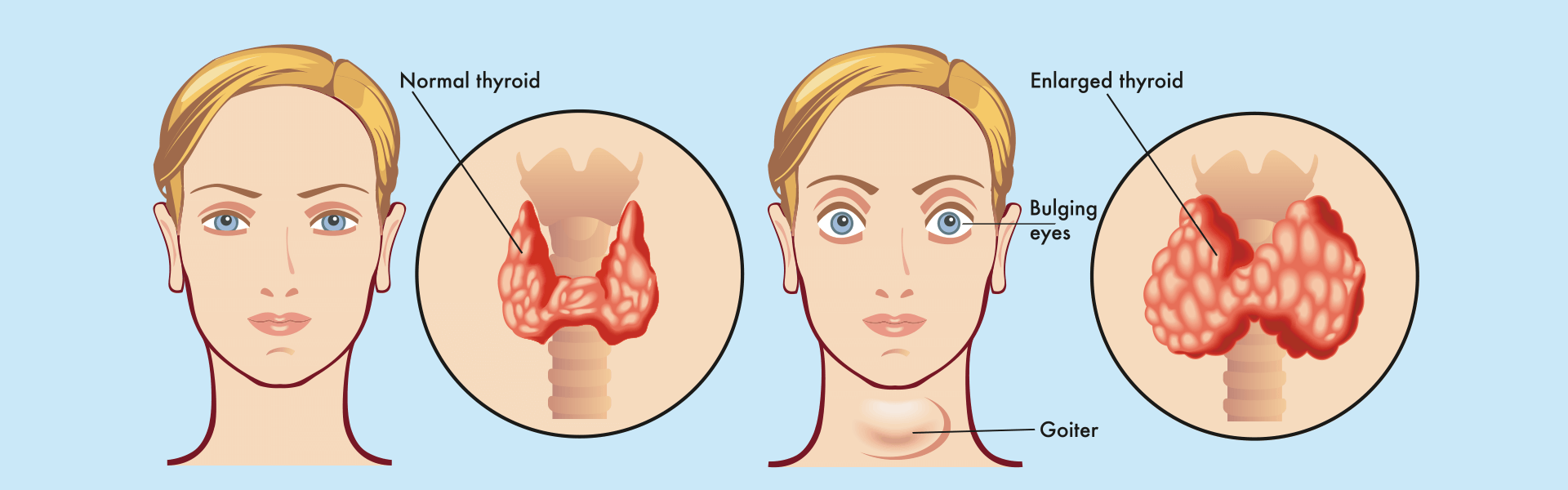 Thyroid Scan | Manipal Hospitals India